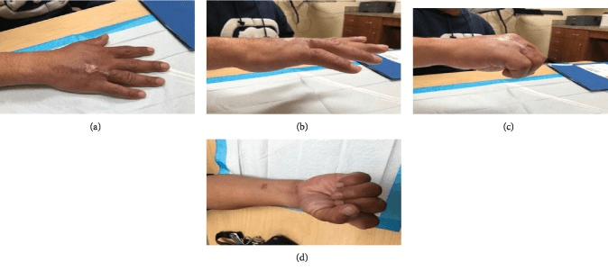 Three-month motion after Zone V extensor tendon reconstruction