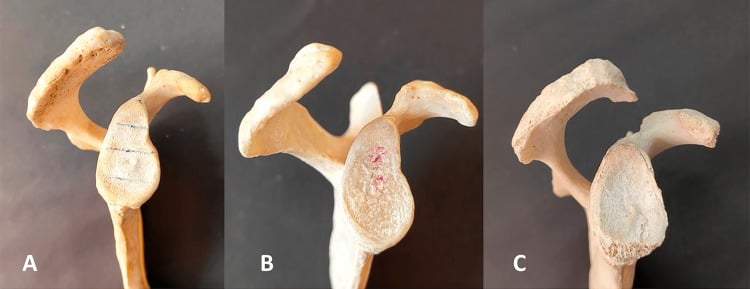 Three-panel photograph of scapulae showing Bigliani acromion types on bone specimens