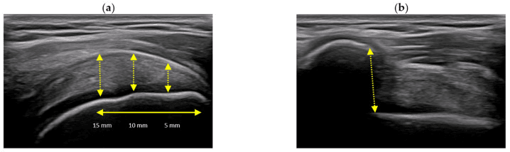 Ultrasound measuring supraspinatus thickness at points marked 15, 10 and 5 mm (a) and the acromiohumeral distance (b)