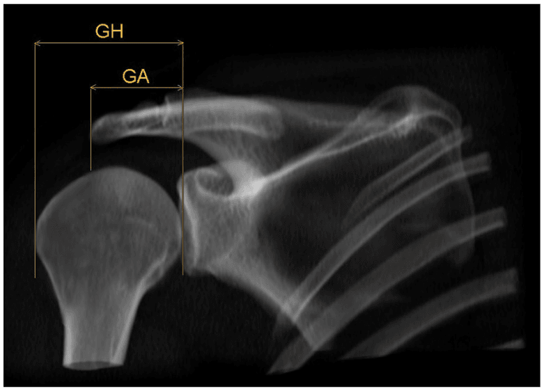 Shoulder image with acromion index measurement lines labelled GA and GH