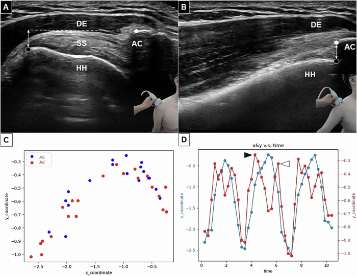 Dynamic shoulder ultrasound in two arm positions (A, B) with DE, SS, HH and AC labelled and the acromiohumeral distance marked, above two coordinate plots (C, D)