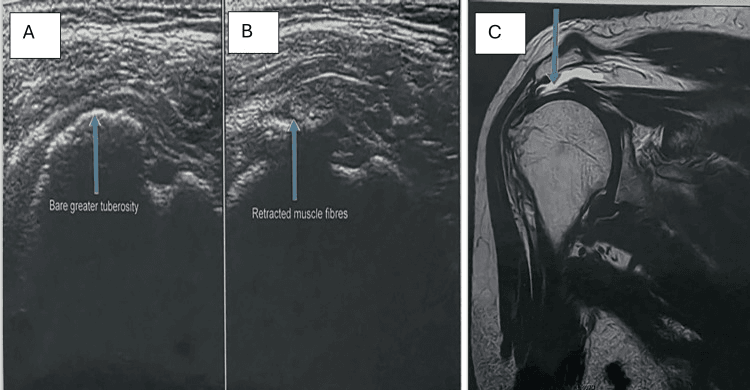 Two ultrasound panels labelled bare greater tuberosity and retracted muscle fibres (A, B) with a matching MRI (C) of a full-thickness supraspinatus tear