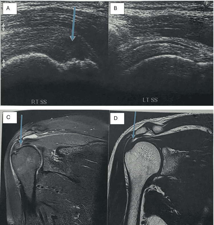 Ultrasound of the right and left supraspinatus (A, B) and two MRI images (C, D), with arrows marking a partial-thickness supraspinatus tear