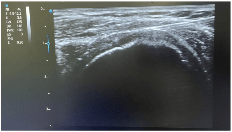 Ultrasound image of needle placement for subacromial bursa injection