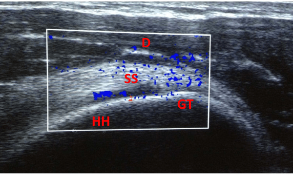 Power Doppler ultrasound of the supraspinatus tendon (SS) showing intratendinous vascular signal, with D, GT and HH labelled