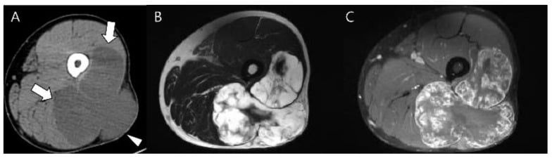 Axial CT and coronal T2 MRI of thigh extraskeletal myxoid chondrosarcoma