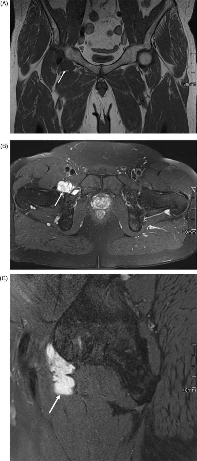 Axial post-contrast fat-saturated T1 MRI demonstrating peripheral and septal enhancement in EMC
