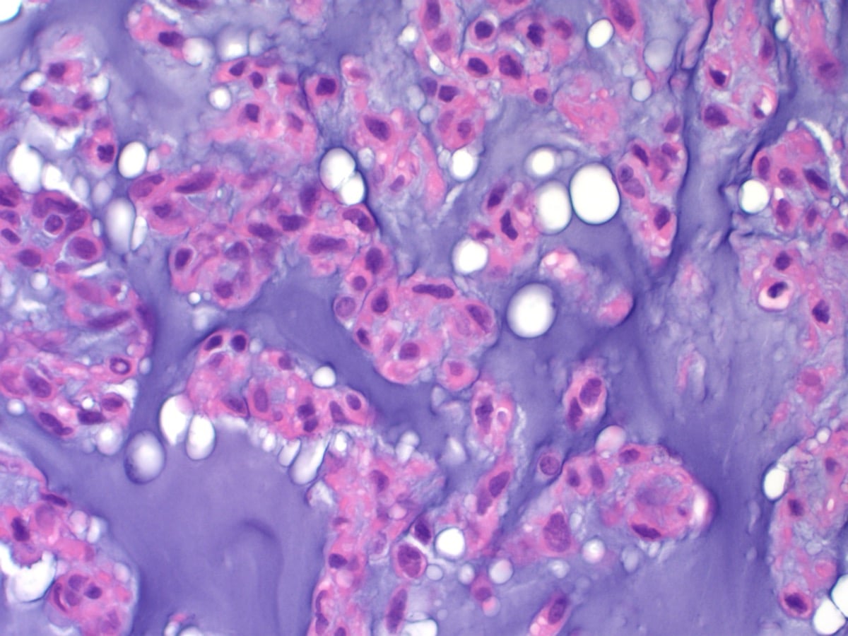 High-power histology of extraskeletal myxoid chondrosarcoma showing eosinophilic ovoid cells in cords within myxoid matrix