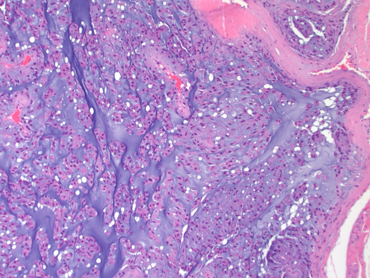 Histology of extraskeletal myxoid chondrosarcoma showing multilobular architecture with cords of cells in an abundant myxoid matrix