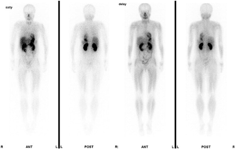 Thallium-201 nuclear scintigram of extraskeletal osteosarcoma