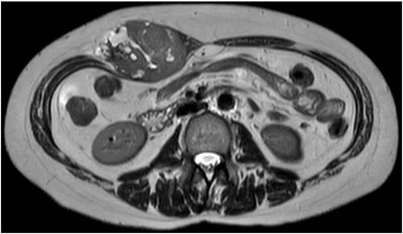 Axial T2 MRI demonstrating progressive expansile intramuscular growth in ESO