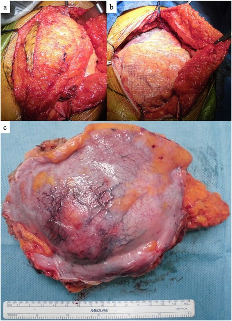 Gross surgical specimen of en bloc wide resection for extraskeletal osteosarcoma