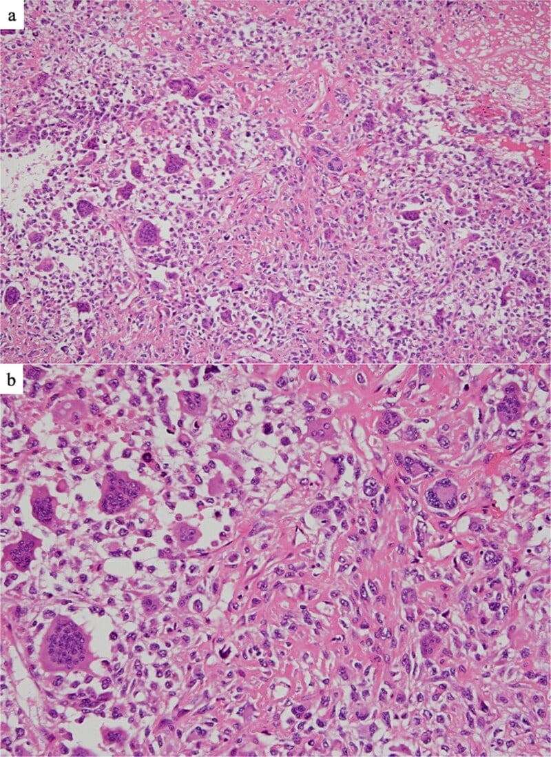 H&E histology of extraskeletal osteosarcoma showing malignant osteoid, severe nuclear atypia, and osteoclast-like giant cells