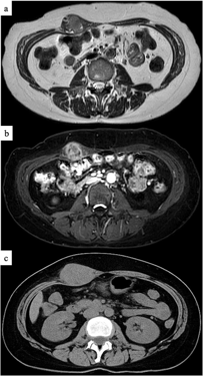 Axial T2-weighted, gadolinium-enhanced MRI, and CT images of an extraskeletal osteosarcoma in the abdominal wall