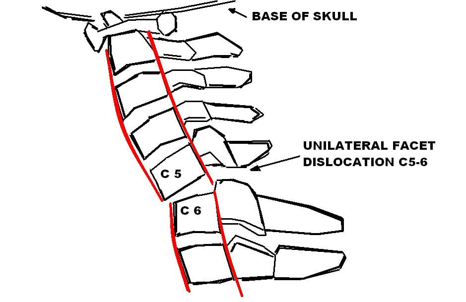 Cervical Facet Dislocations - Anatomic diagram showing unilateral facet dislocation at C5-6 with vertebral alignment.