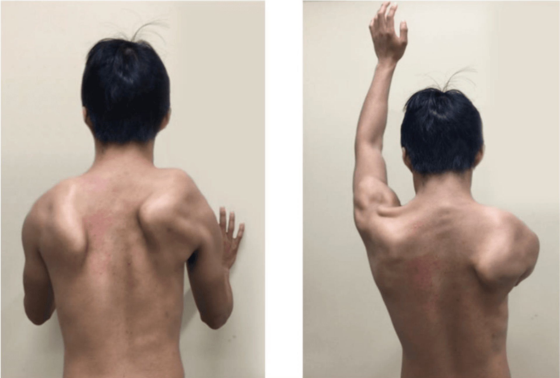 Posterior view of bilateral scapular winging at rest and on arm elevation