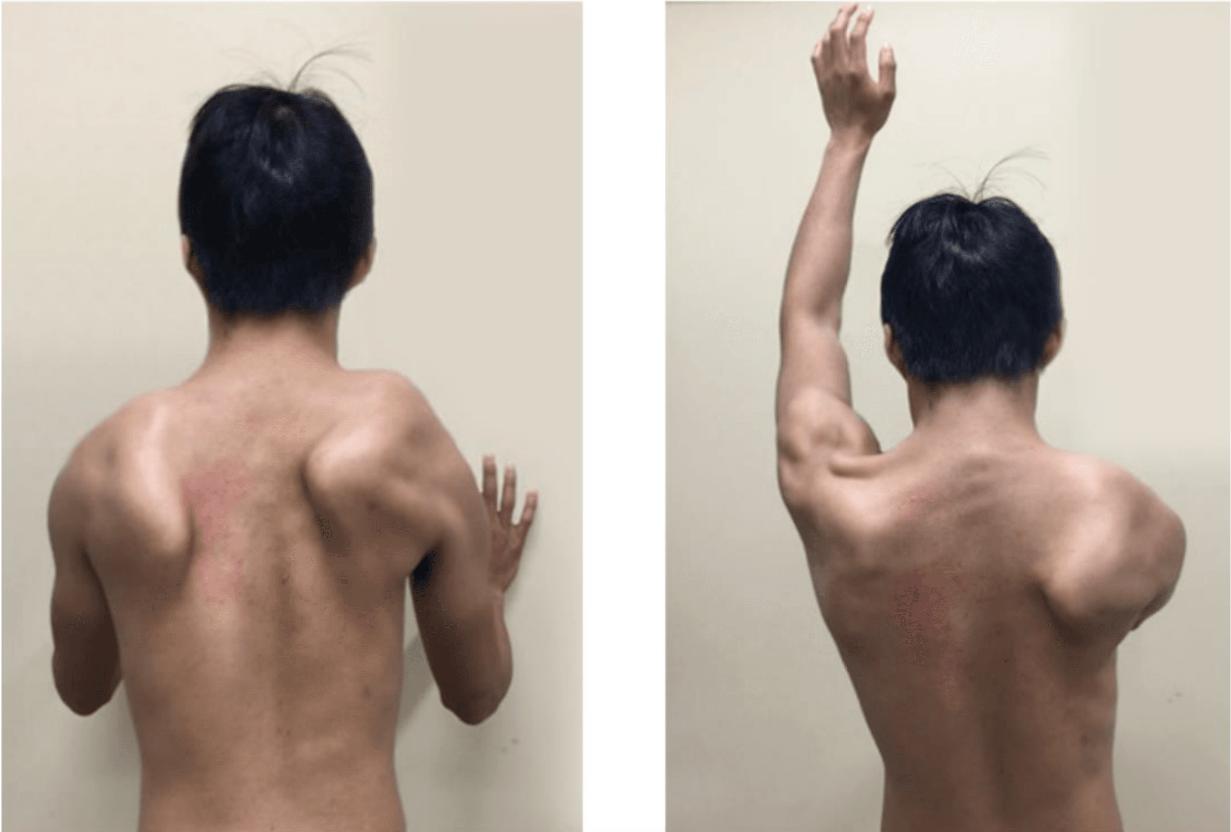 Posterior view of bilateral scapular winging at rest and on arm elevation