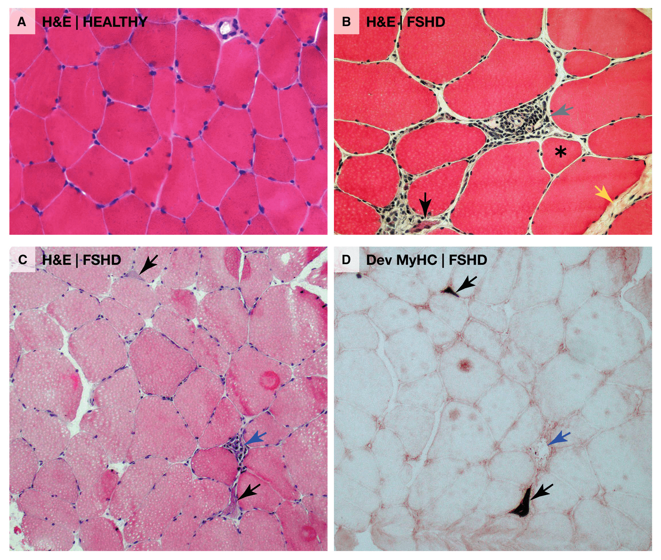 Muscle histology comparing healthy polygonal fibres with the rounded, variably sized fibres of FSHD-affected muscle