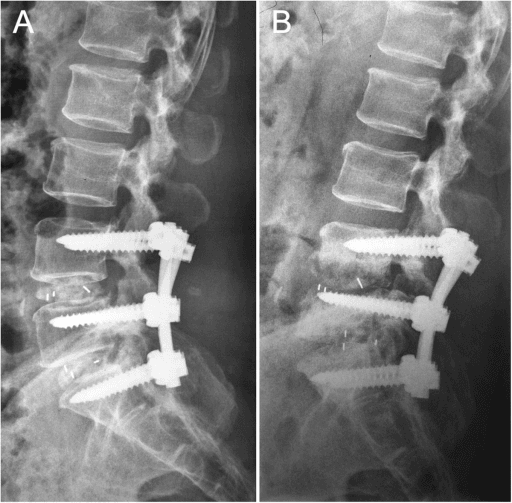 Lateral radiographs of an instrumented posterior lumbar fusion (pedicle screws).