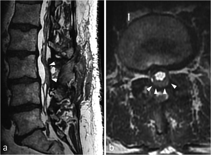 Postoperative lumbar MRI, sagittal and axial, with arrowheads on clumped cauda equina nerve roots.