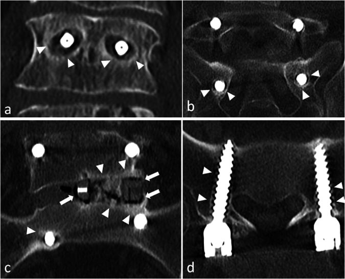 Multiplanar CT after instrumented lumbar fusion, four panels, with arrowheads on lucency around the pedicle screws.