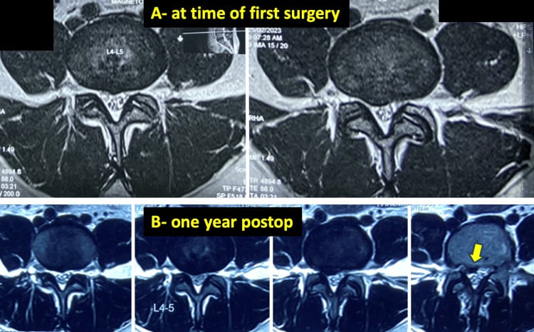 Axial lumbar MRI at L4-L5 at the time of first surgery and one year after it, an arrow marking recurrent disc material.