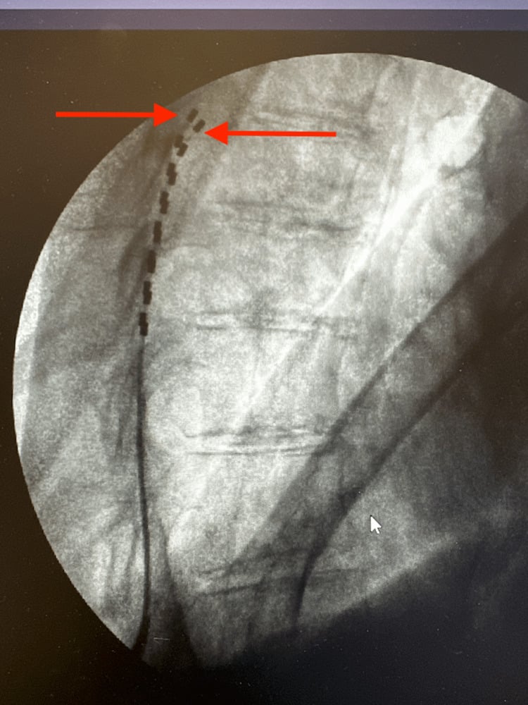 Fluoroscopic image during epidural lead placement, arrows marking the upper end of the radiopaque electrode array.