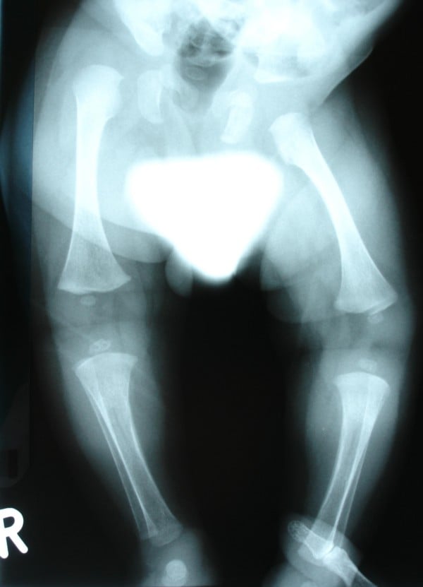 AP lower limb radiograph demonstrating osteopenia and insensate limb fractures