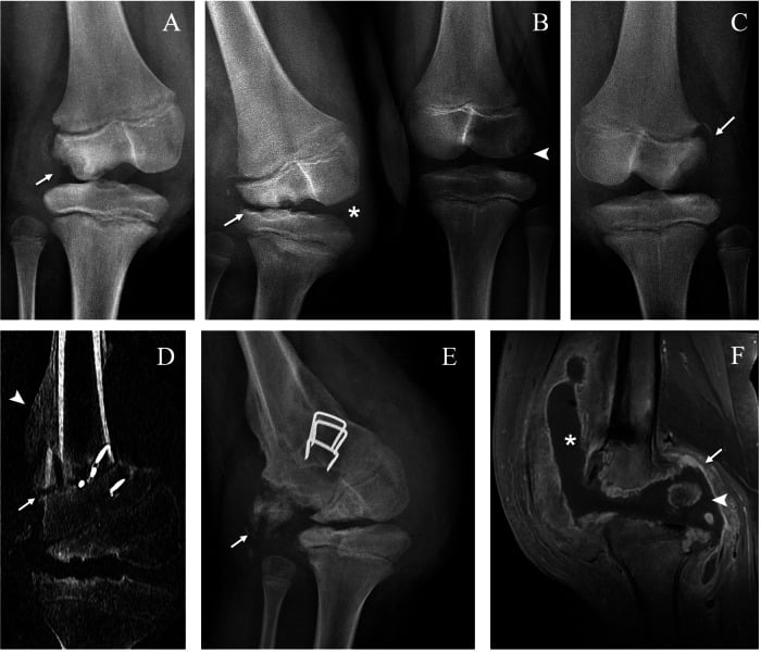 Radiographs, CT, and MRI of bilateral knee Charcot neuroarthropathy