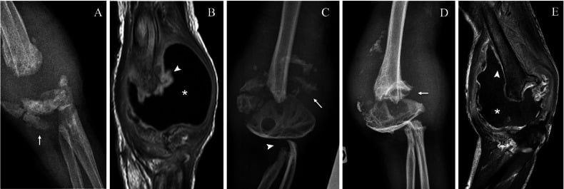 Radiographs, 3D CT, and MRI of elbow Charcot neuroarthropathy