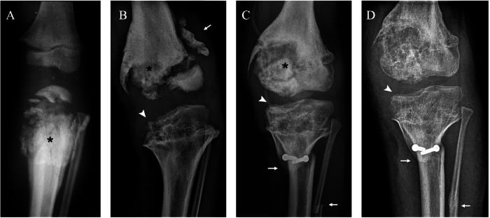 AP radiographs of progressive knee Charcot neuroarthropathy