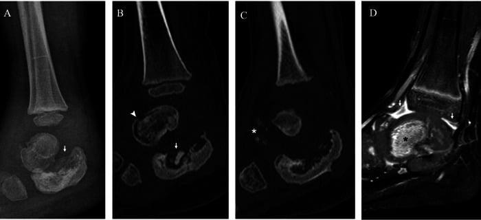 Lateral radiographs demonstrating ankle Charcot neuroarthropathy and talar collapse