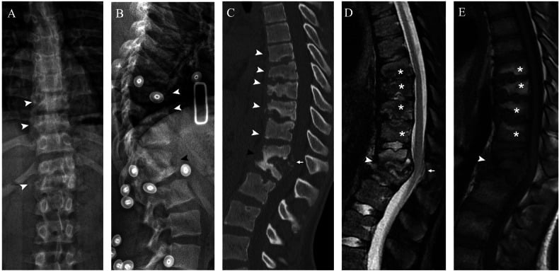 Sagittal CT and MRI of neuropathic spinal deformity and Charcot spine osteolysis