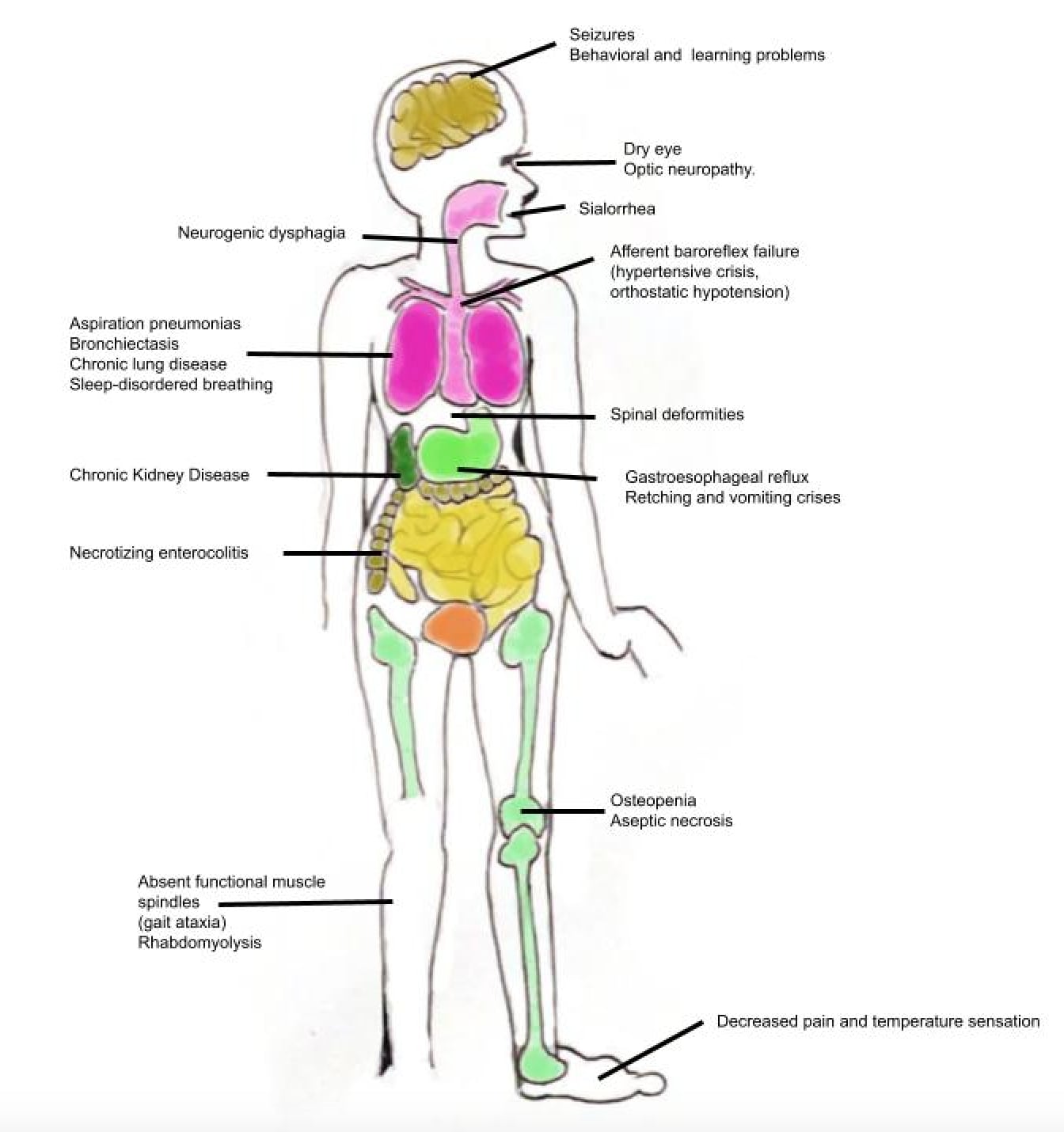 Illustrated chart showing the multisystem manifestations of familial dysautonomia, including spinal deformities and decreased pain and temperature sensation
