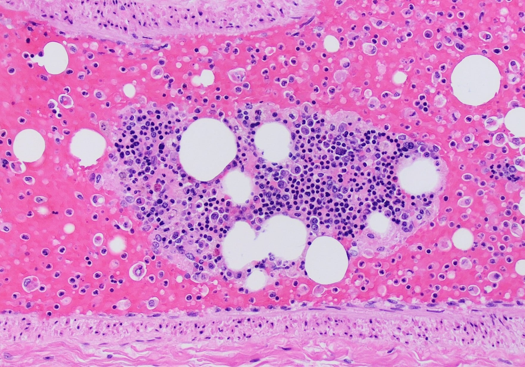 H&E histology showing fat globules (clear round vacuoles) in fat embolism.