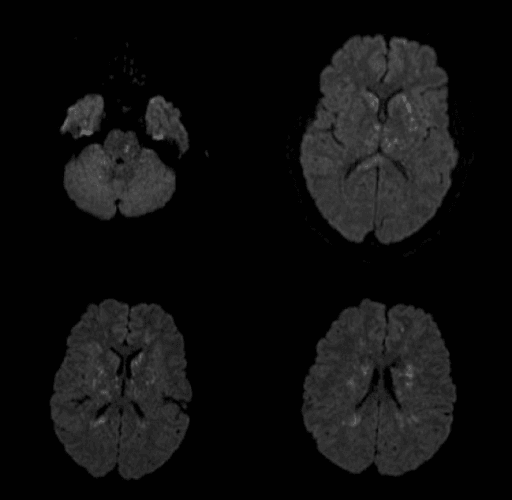 Brain diffusion MRI showing punctate restricted-diffusion lesions in cerebral fat embolism