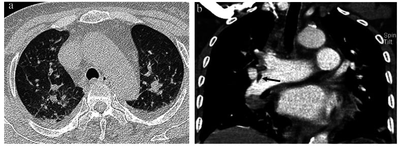 High-resolution and pulmonary-artery CT showing ground-glass opacity and a fat embolus