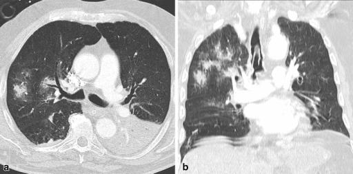 Axial and coronal chest CT showing multifocal bilateral air-space opacities after intertrochanteric fracture