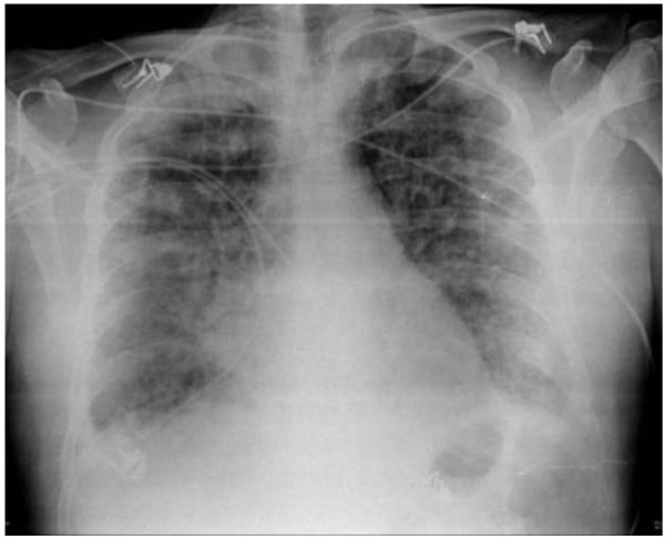 AP chest radiograph after tibial nailing showing diffuse bilateral pulmonary infiltrates