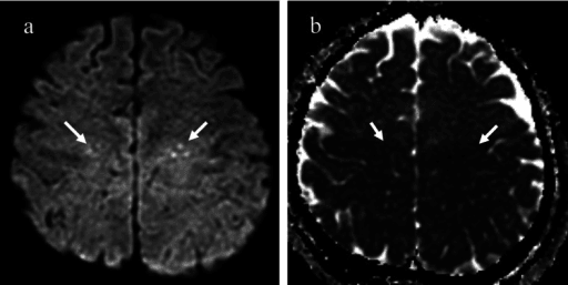 Paired diffusion-weighted and ADC brain MRI showing cerebral fat embolism lesions