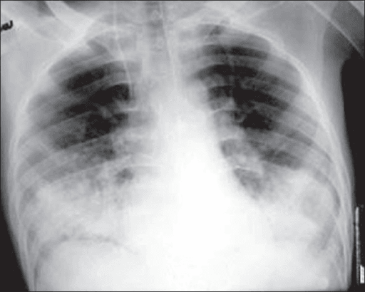 AP chest radiograph showing bilateral basal air-space filling lesions in fat embolism syndrome