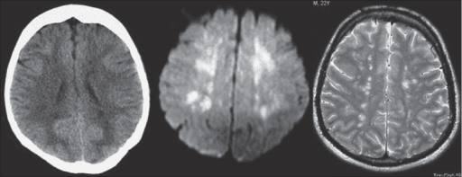 CT, diffusion-weighted and T2 brain MRI panels showing cerebral fat embolism