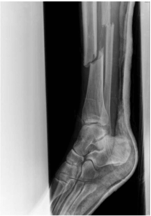 Lateral radiograph of an open distal tibial fracture before intramedullary nailing