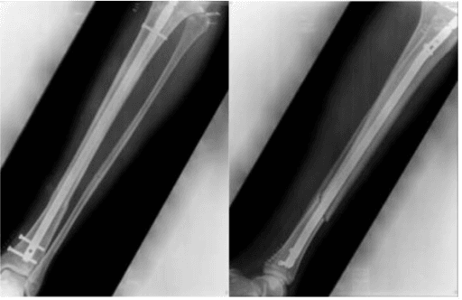 AP and lateral radiographs of the tibia after intramedullary nailing