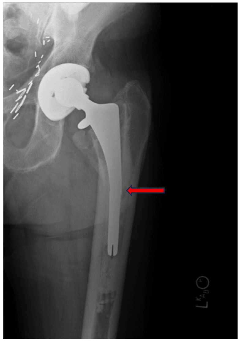 Radiograph localising a cemented hip stem fracture