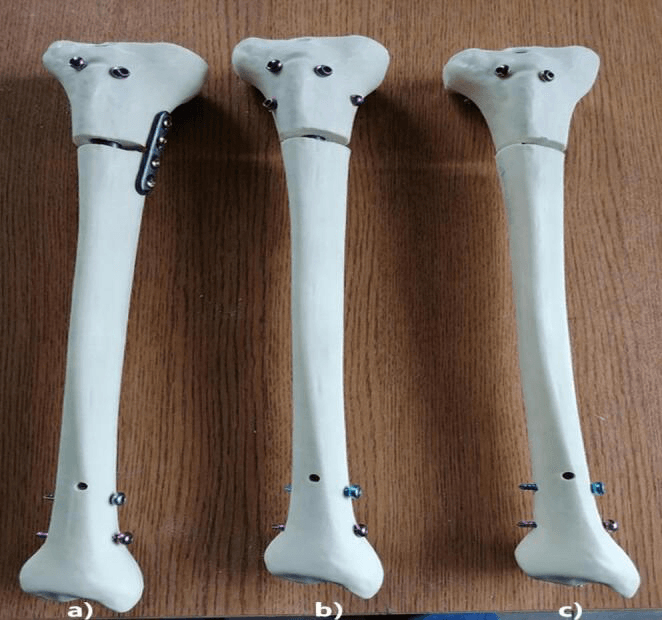 Synthetic tibial constructs with nail plate and Poller-screw configurations