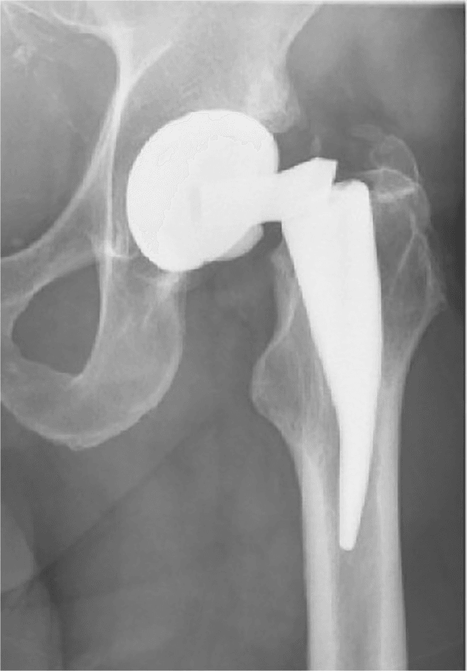 Radiograph of fractured Ti-6Al-4V cementless hip stem