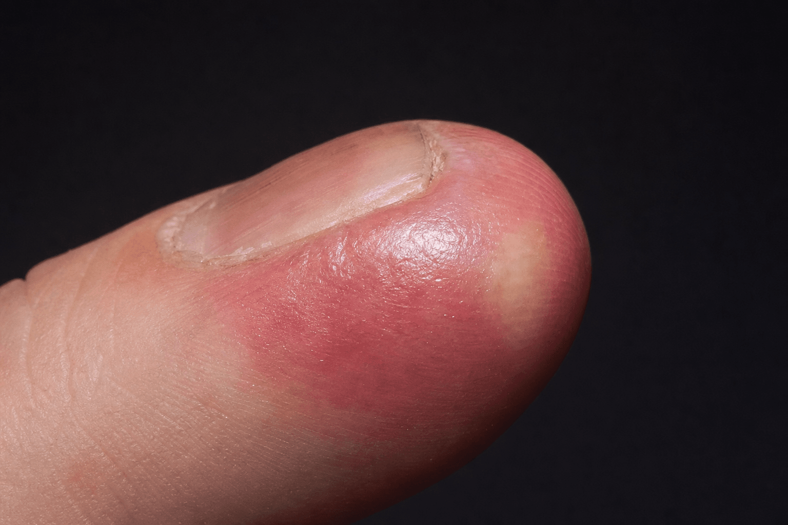 Close-up clinical photograph of a fingertip with a felon — tensely swollen, erythematous, shiny distal pulp.