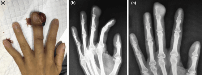 Fungating finger mass with radiographs showing eccentric destructive distal phalanx lesion
