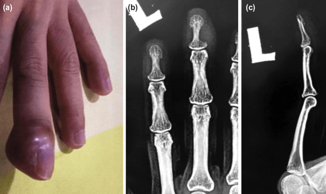 Swollen erythematous finger and radiographs showing distal phalanx scalloping from acrometastasis